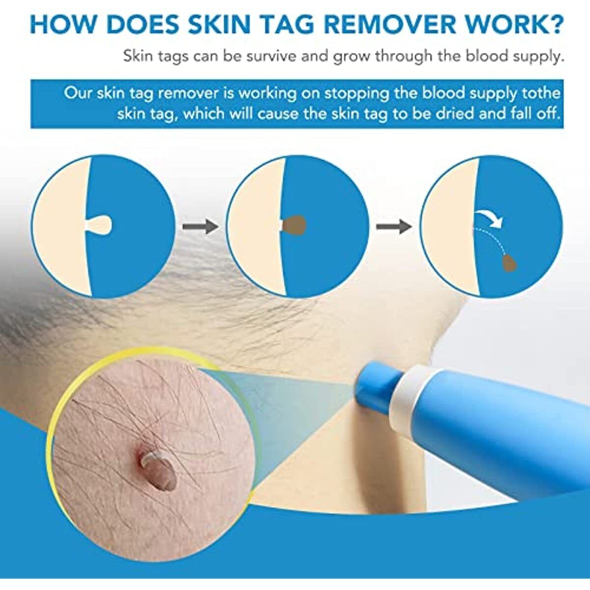 2 in 1 Auto Micro Skin Tag Remover Device Kit Safe Painless Removal 2-8 mm Tool